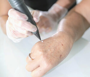 cryotherapy molluscum liver milia benign lesions fibromas keratosis